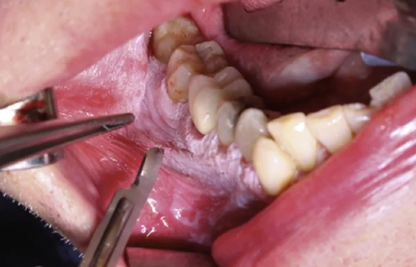 Biopsy