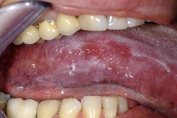 White or Red Lesions of Oral Cavity