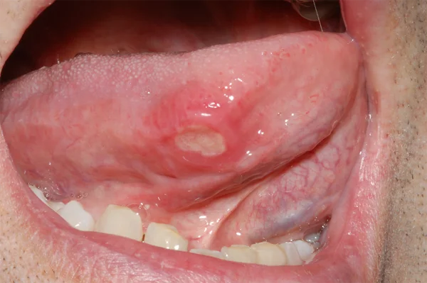 Oral Ulcer