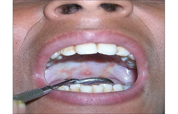 Reduced Mouth Opening