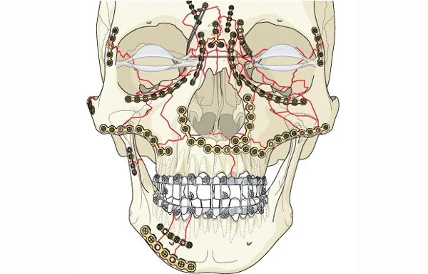 Facial Trauma or Lacerations