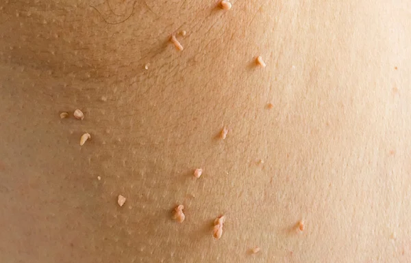 Skin Tag or Wart Removal