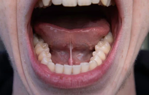 Tongue Tie Removal