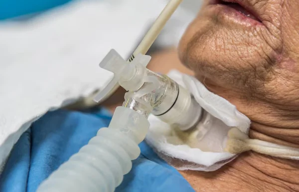 Tracheostomy or Tracheostomy Tube Change