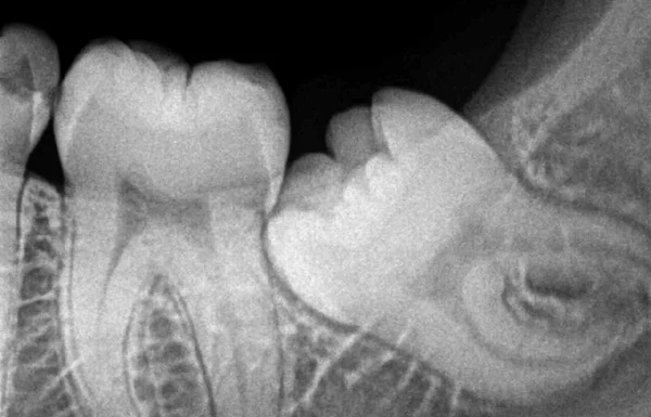 IOPA X Ray