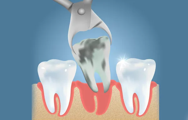 Tooth Extractions