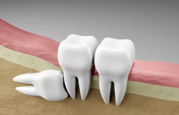 3rd Molar Disimpactions