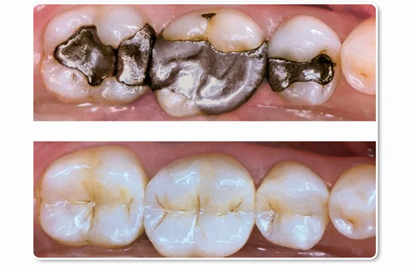 Fillings Composite or GIC