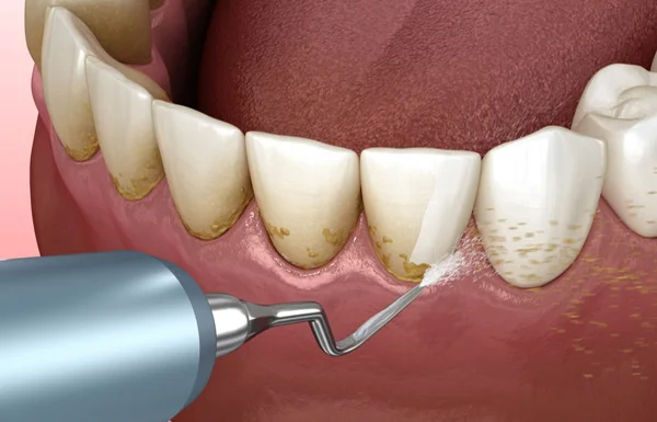 Scaling and Polishing
