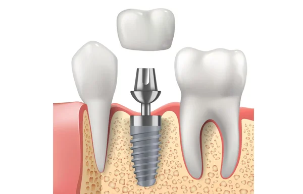 Dental Implants