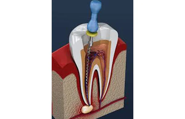 Root Canal Treatment