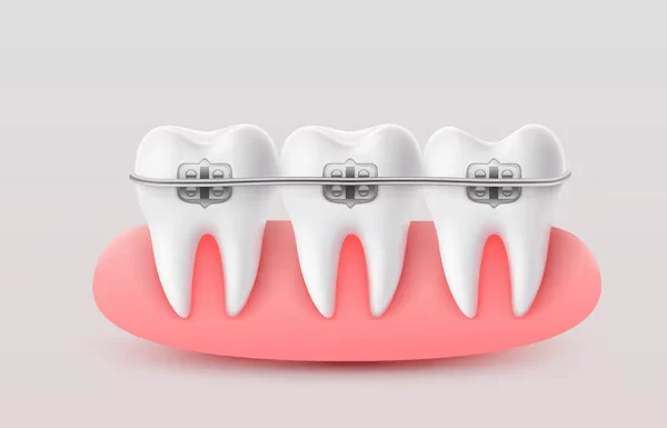 Teeth Straightening
