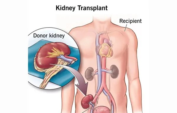 Kidney Transplant