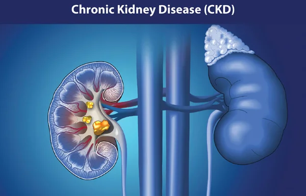 Chronic Kidney Disease