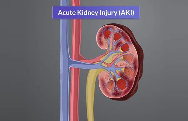 Acute Kidney Injury