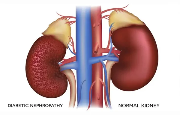 Diabetes Related Kidney Issues
