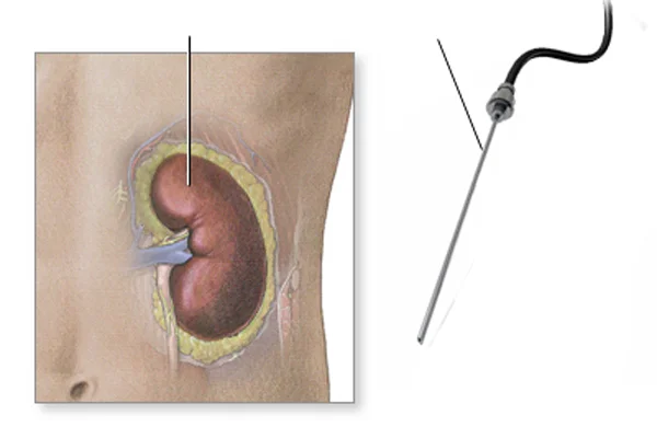 Renal Biopsy