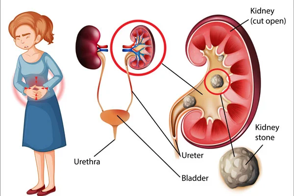 Recurrent Kidney Stones