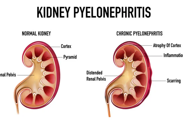 Pyelonephritis