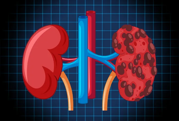Cystic Disease of Kidney