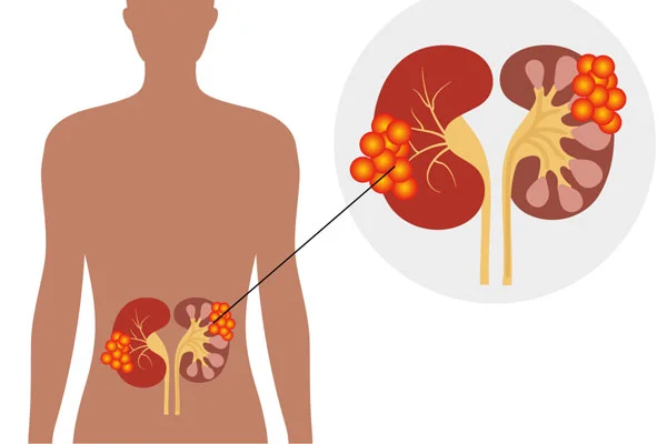 Renal Cell Cancer