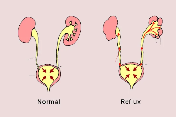 Reflux Nephropathy