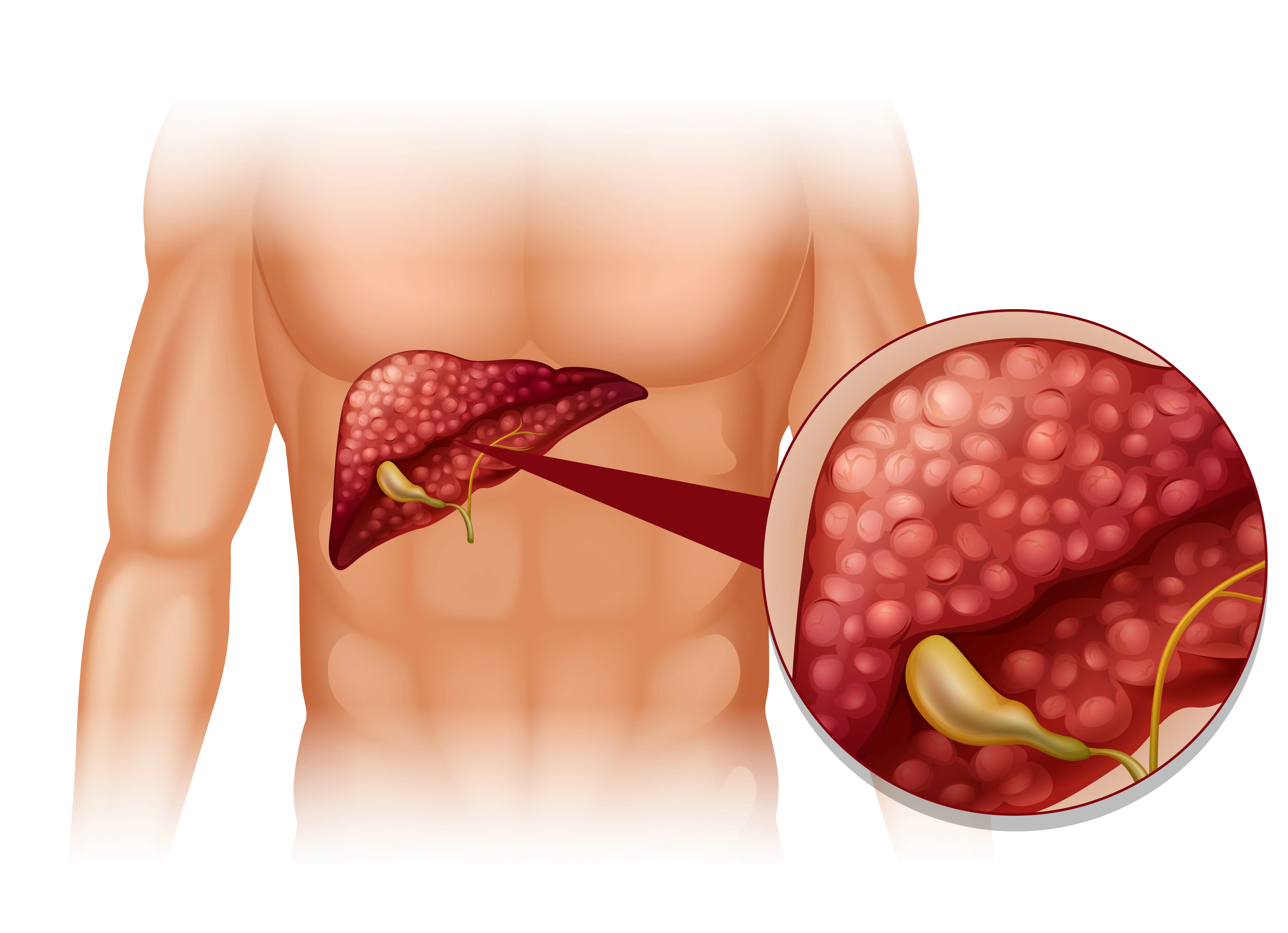 Hepatorenal Syndrome