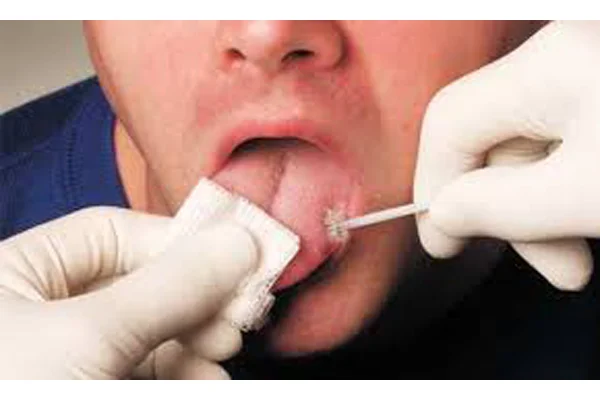 Biopsy