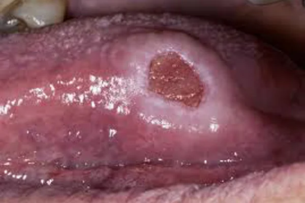Non Healing Ulcers