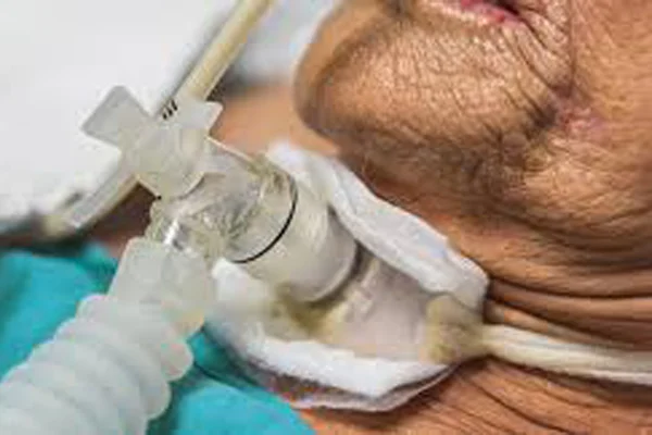 Tracheostomy and Tracheostomy Tube Change