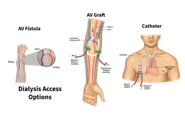Vascular Access for Dialysis